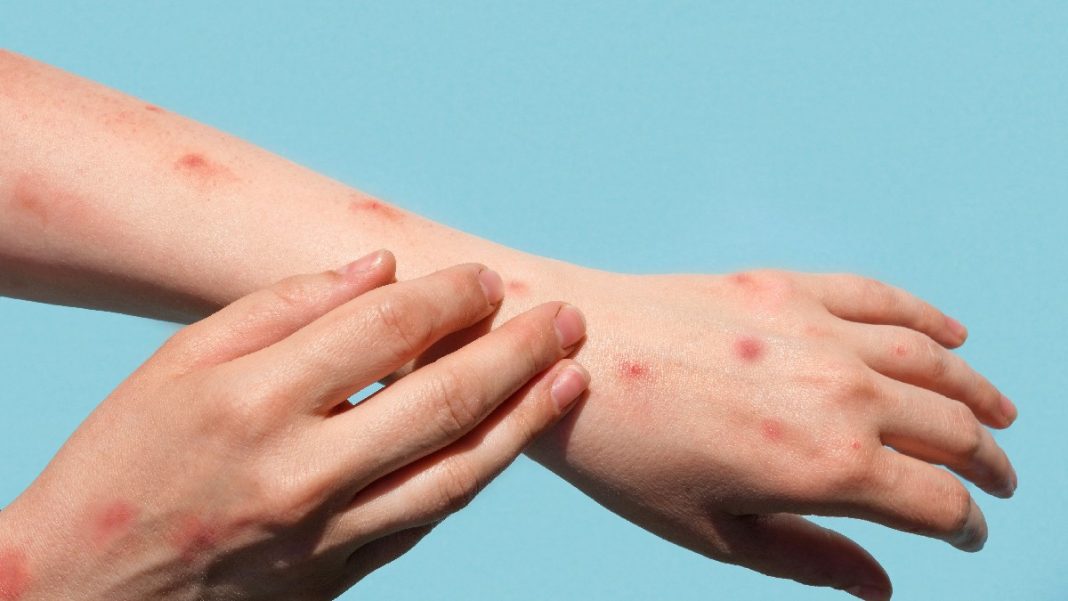 ΕΟΔΥ: Κρούσματα ιλαράς στην Ελλάδα - Συνιστάται άμεσος εμβολιασμός
